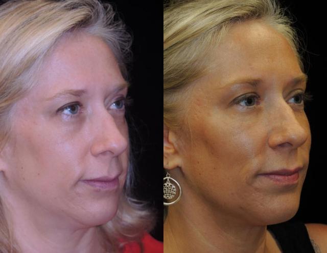 Dermal Fillers result at Kristin J. Tarbet, MD, FACS in Bellevue, WA