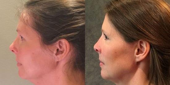 Kybella result at Kristin J. Tarbet, MD, FACS in Bellevue, WA