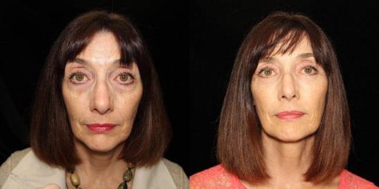 Kristin J. Tarbet, MD, FACS eyelid lift result — Bellevue, WA