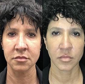 Morpheus8 result at Kristin J. Tarbet, MD, FACS in Bellevue, WA