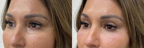 Morpheus8 result at Kristin J. Tarbet, MD, FACS in Bellevue, WA