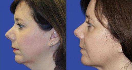 Kybella result at Kristin J. Tarbet, MD, FACS in Bellevue, WA