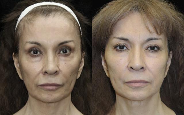 Dermal Fillers result at Kristin J. Tarbet, MD, FACS in Bellevue, WA