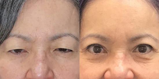 Kristin J. Tarbet, MD, FACS eyelid lift result — Bellevue, WA