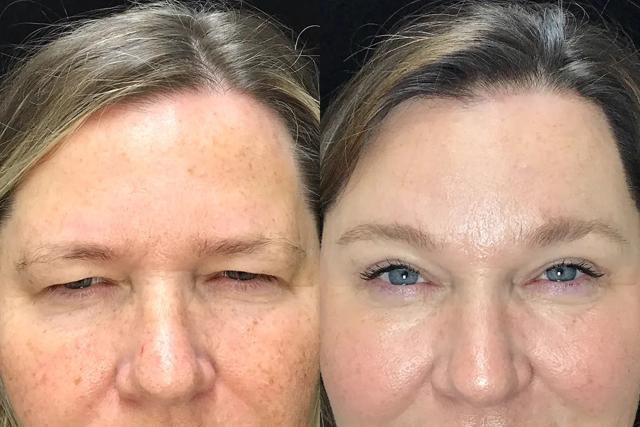 Brow Lift result at Kristin J. Tarbet, MD, FACS in Bellevue, WA