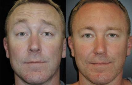 Botox result at Kristin J. Tarbet, MD, FACS in Bellevue, WA