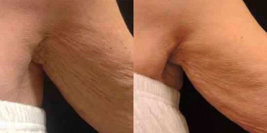 Kybella result at Kristin J. Tarbet, MD, FACS in Bellevue, WA