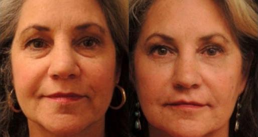 Dermal Fillers result at Kristin J. Tarbet, MD, FACS in Bellevue, WA