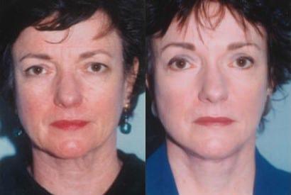 Neck Liposuction result at Kristin J. Tarbet, MD, FACS in Bellevue, WA