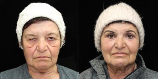 Kristin J. Tarbet, MD, FACS eyelid lift result — Bellevue, WA