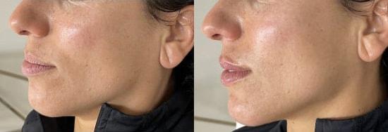 Dermal Fillers result at Kristin J. Tarbet, MD, FACS in Bellevue, WA