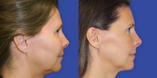 Kybella result at Kristin J. Tarbet, MD, FACS in Bellevue, WA