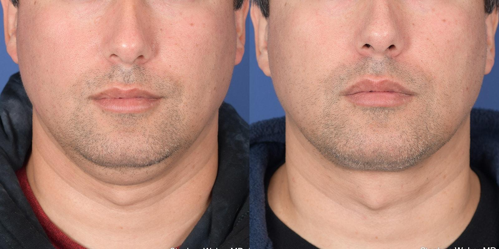 Weber Facial Plastic Surgery neck lift result — Lone Tree, CO