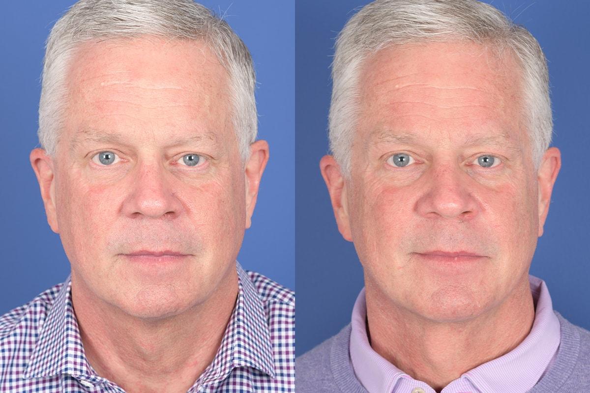 Weber Facial Plastic Surgery neck lift result — Lone Tree, CO