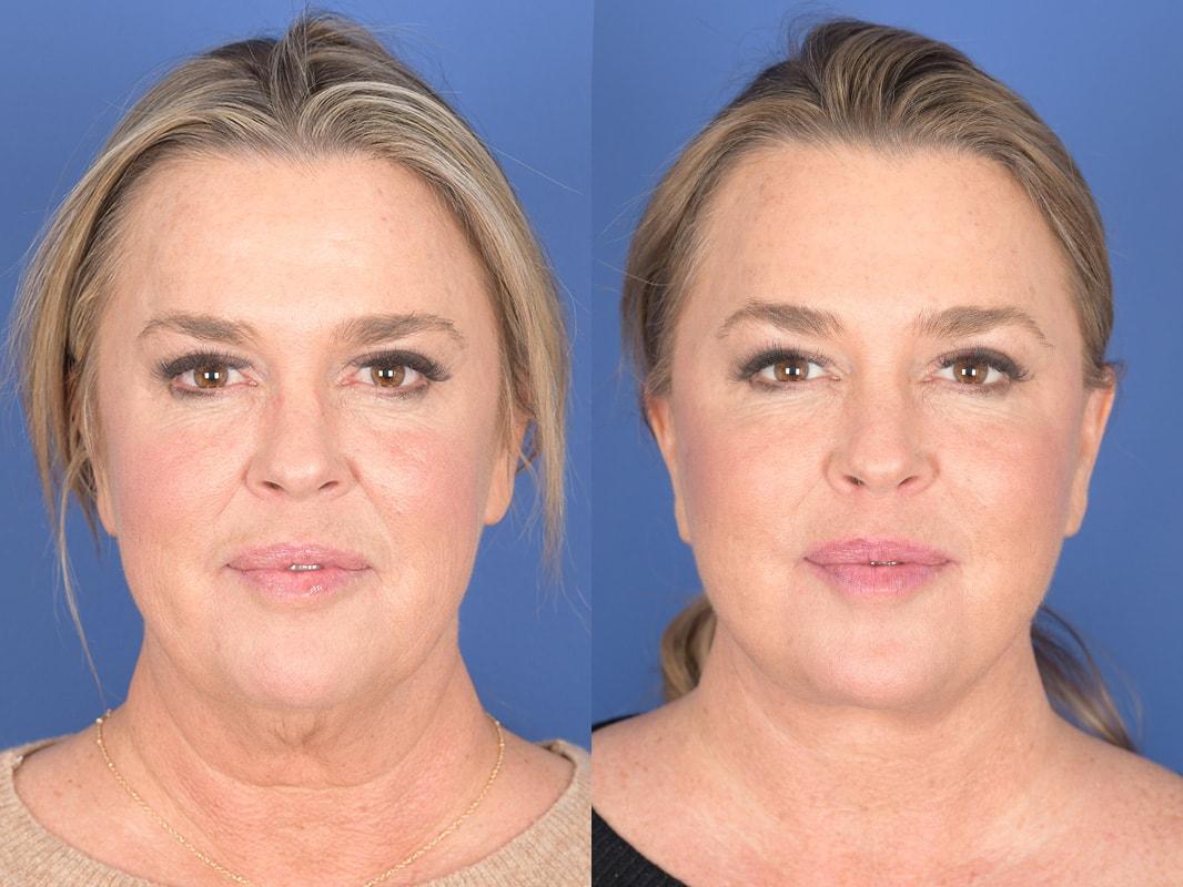 Weber Facial Plastic Surgery facelift result — Lone Tree, CO
