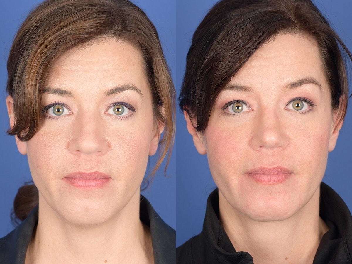 Weber Facial Plastic Surgery neck lift result — Lone Tree, CO