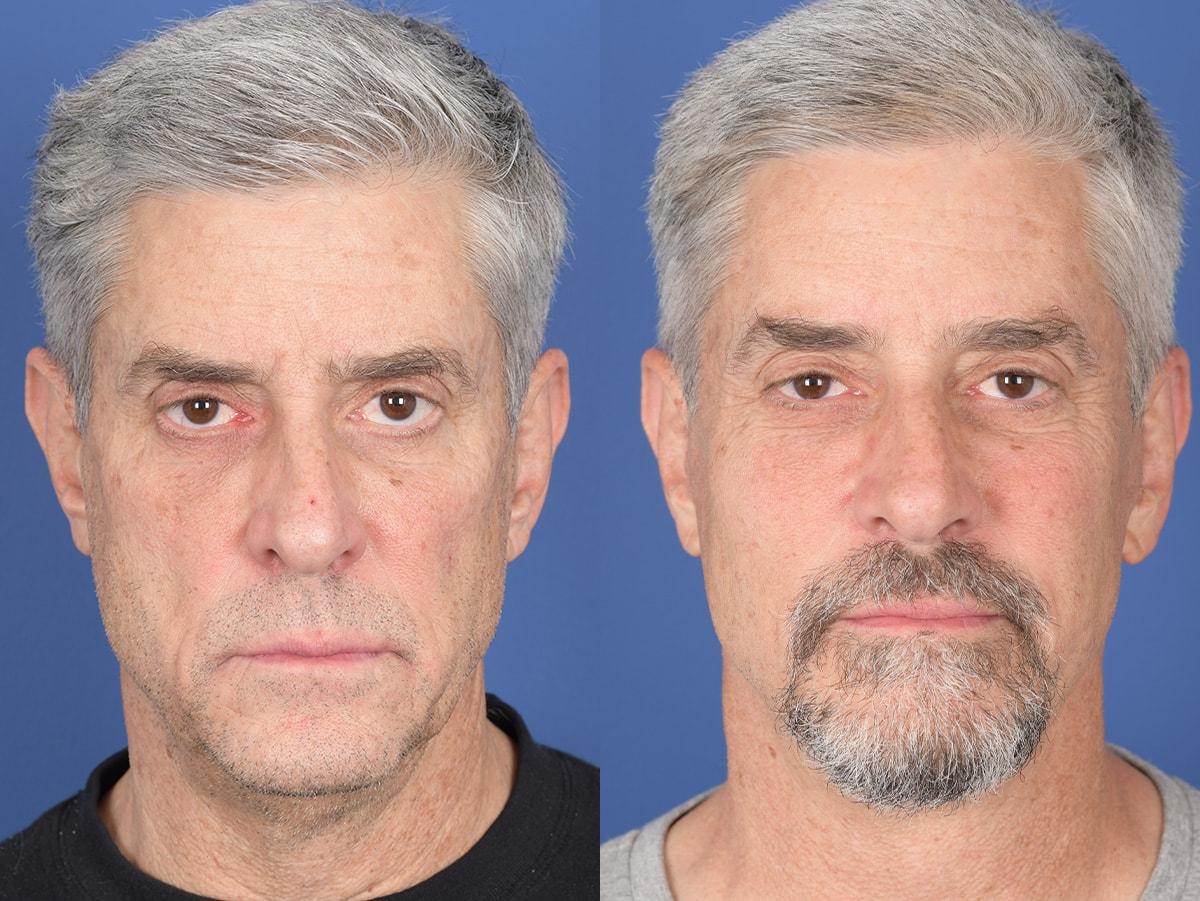 Weber Facial Plastic Surgery facelift result — Lone Tree, CO
