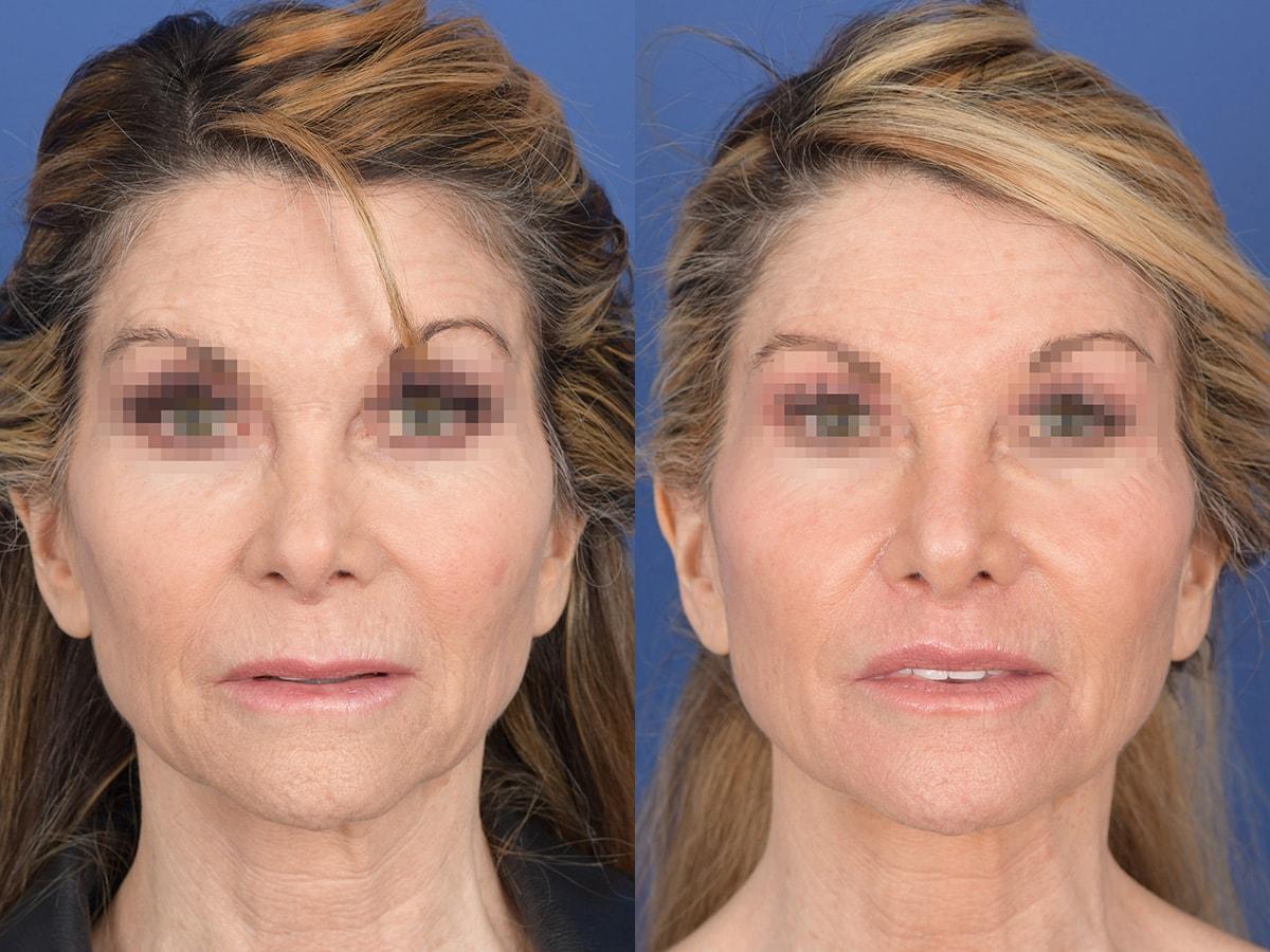 Weber Facial Plastic Surgery rhinoplasty result — Lone Tree, CO