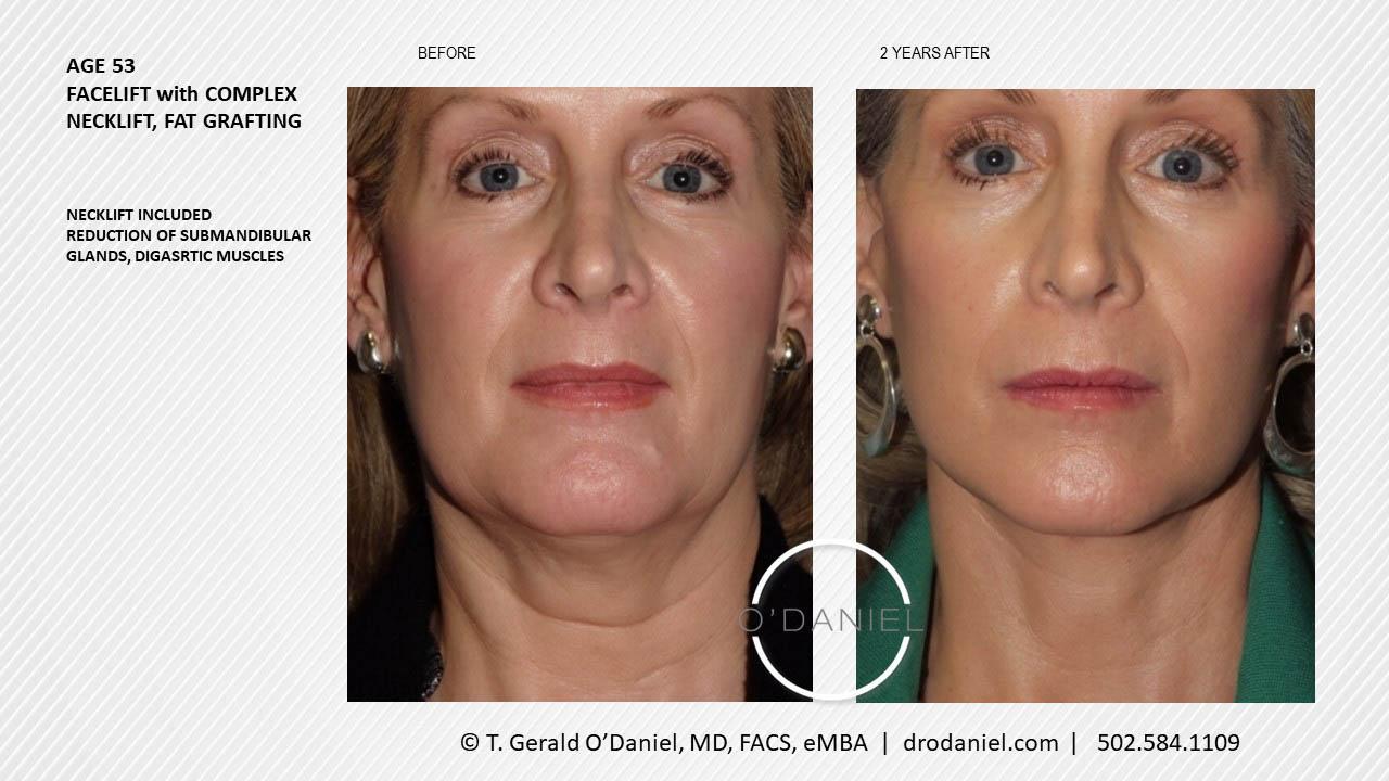 O'Daniel Studios - T. Gerald O'Daniel, MD, FACS rhinoplasty result — Louisville, KY