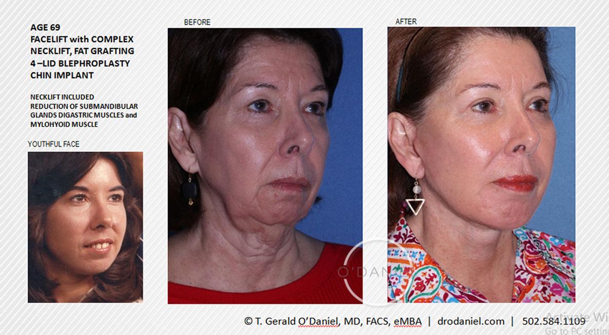 O'Daniel Studios - T. Gerald O'Daniel, MD, FACS rhinoplasty result — Louisville, KY