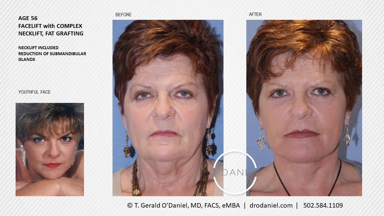O'Daniel Studios - T. Gerald O'Daniel, MD, FACS rhinoplasty result — Louisville, KY