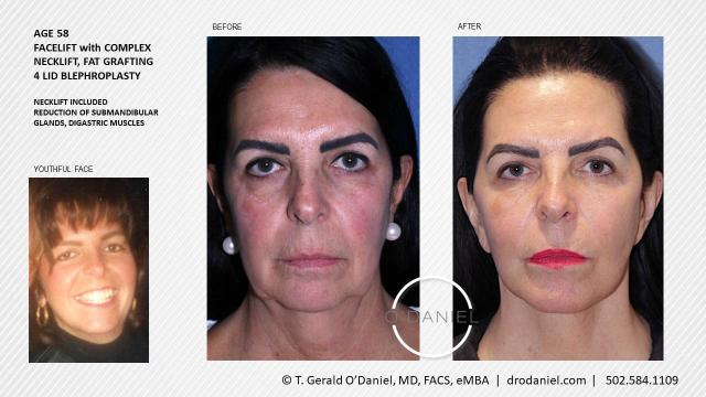 Liquid Rhinoplasty result at O'Daniel Studios - T. Gerald O'Daniel, MD, FACS in Louisville, KY