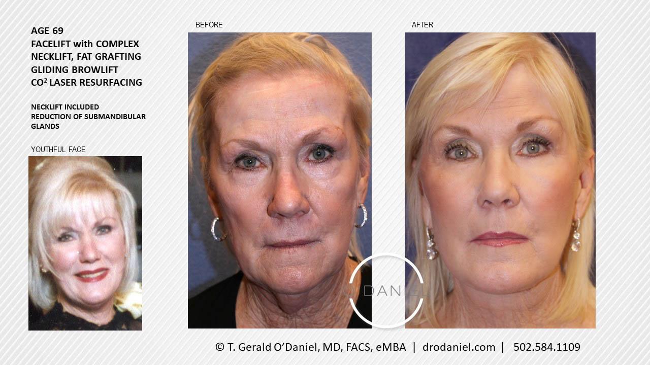 O'Daniel Studios - T. Gerald O'Daniel, MD, FACS rhinoplasty result — Louisville, KY
