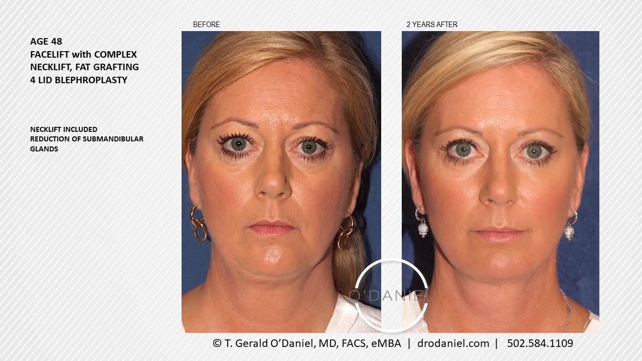 O'Daniel Studios - T. Gerald O'Daniel, MD, FACS rhinoplasty result — Louisville, KY