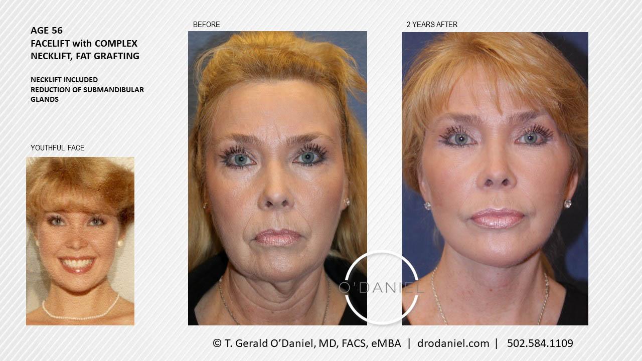 O'Daniel Studios - T. Gerald O'Daniel, MD, FACS rhinoplasty result — Louisville, KY