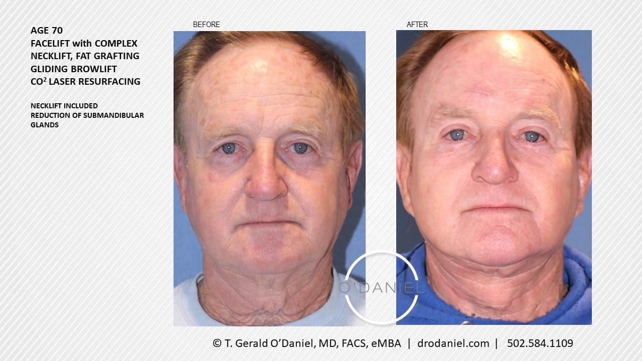 O'Daniel Studios - T. Gerald O'Daniel, MD, FACS rhinoplasty result — Louisville, KY