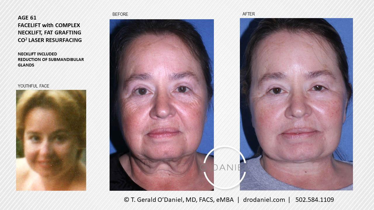O'Daniel Studios - T. Gerald O'Daniel, MD, FACS rhinoplasty result — Louisville, KY