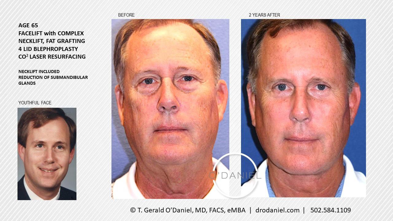O'Daniel Studios - T. Gerald O'Daniel, MD, FACS rhinoplasty result — Louisville, KY
