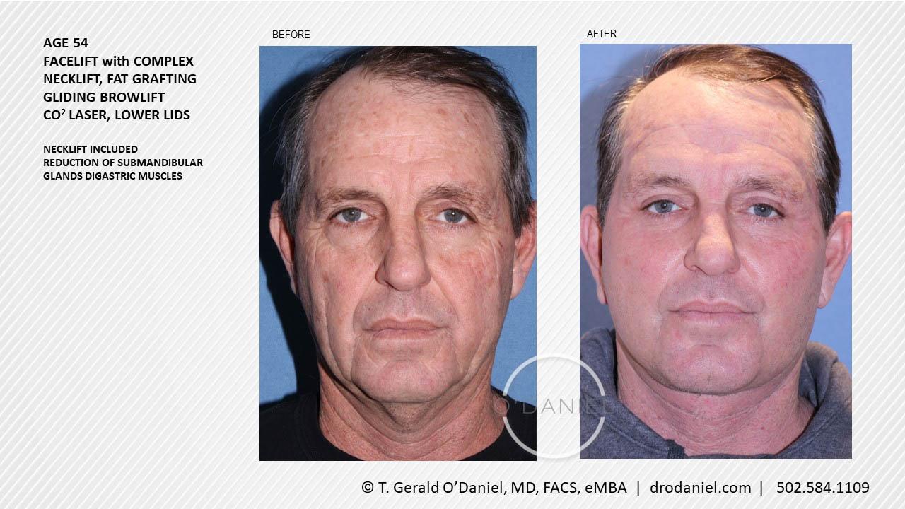 O'Daniel Studios - T. Gerald O'Daniel, MD, FACS facelift result — Louisville, KY