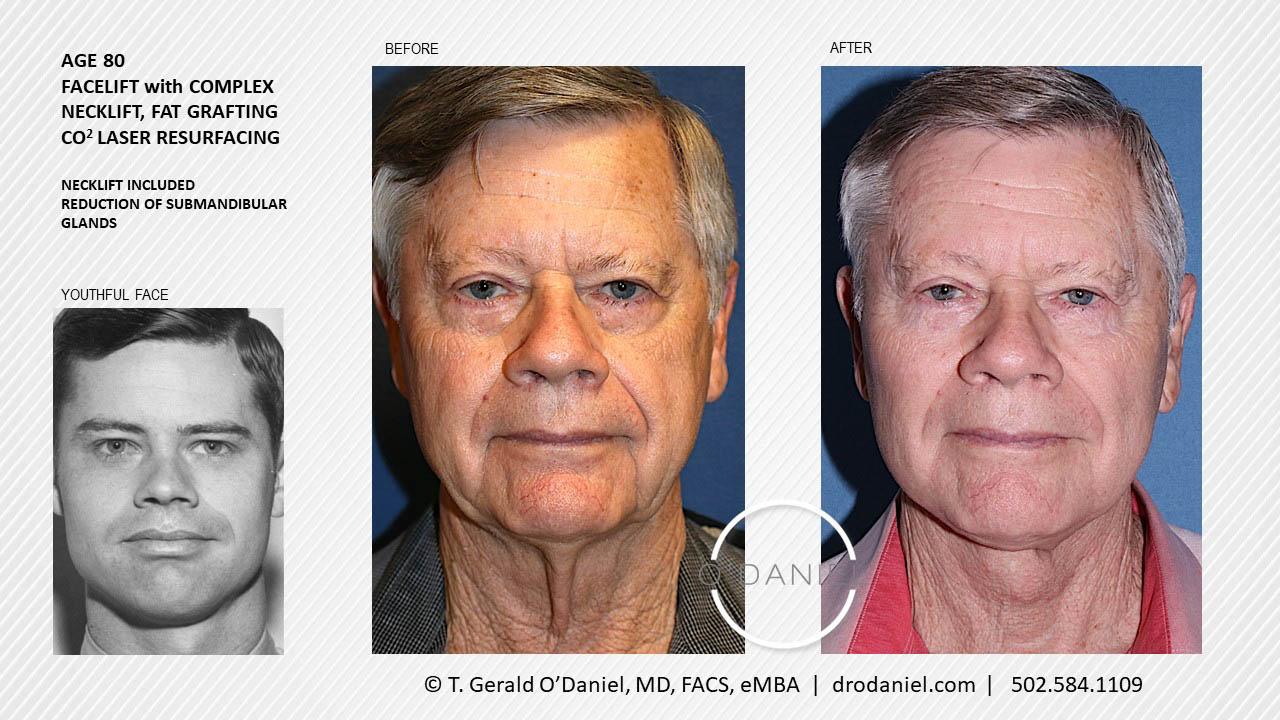O'Daniel Studios - T. Gerald O'Daniel, MD, FACS rhinoplasty result — Louisville, KY