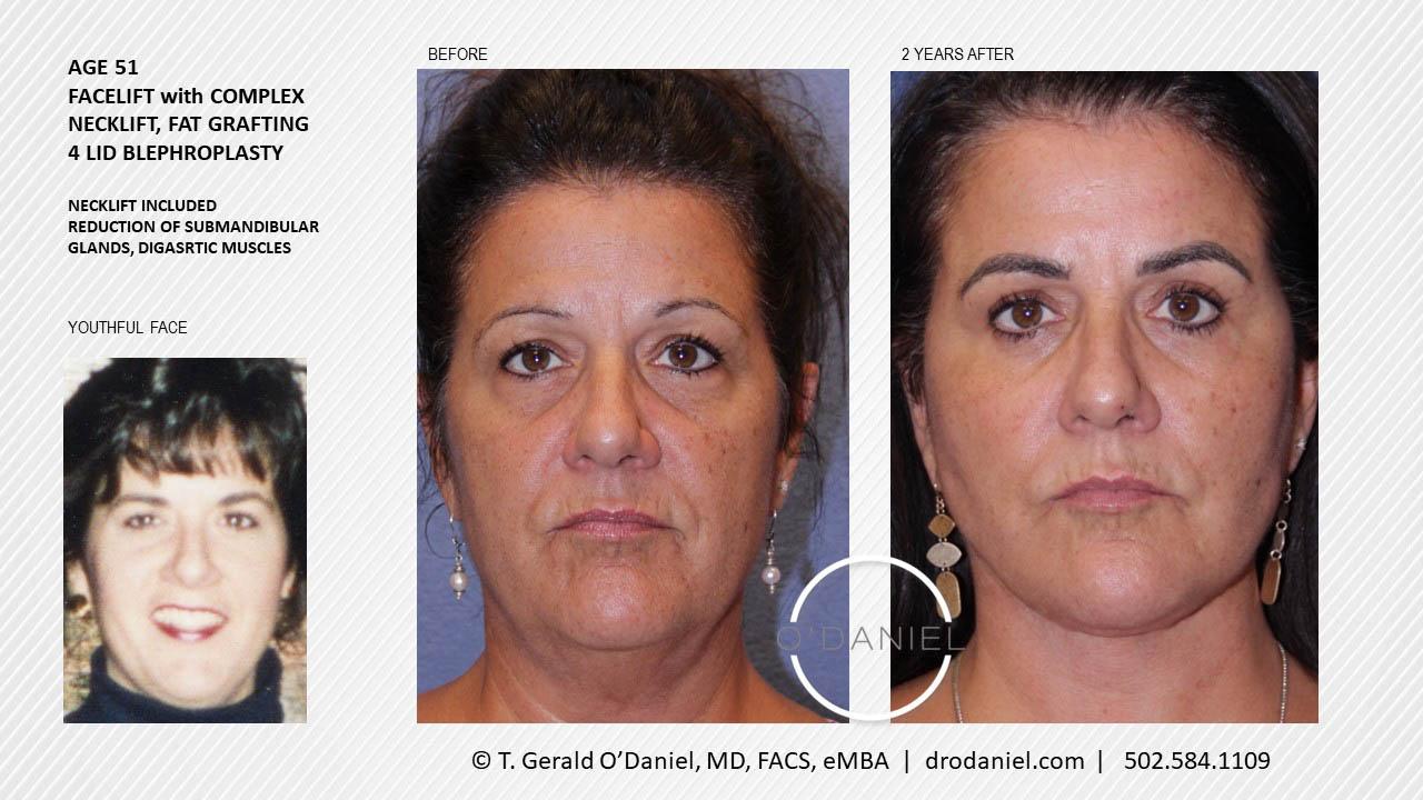 O'Daniel Studios - T. Gerald O'Daniel, MD, FACS rhinoplasty result — Louisville, KY