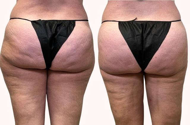 Liposuction result at Melanie L. Aya-ay, MD in Tampa, FL