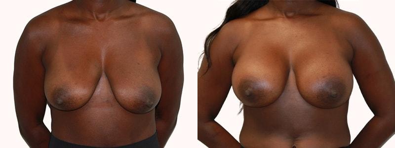 Melanie L. Aya-ay, MD breast augmentation result — Tampa, FL