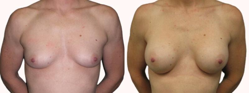 Melanie L. Aya-ay, MD breast augmentation result — Tampa, FL