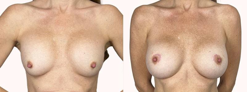 Melanie L. Aya-ay, MD breast augmentation revision result — Tampa, FL