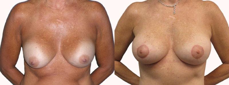 Melanie L. Aya-ay, MD breast lift result — Tampa, FL
