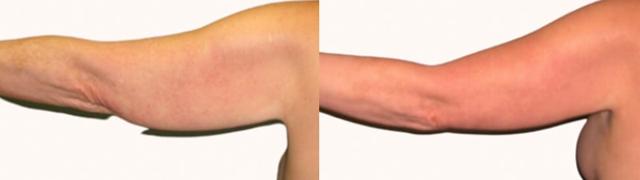 Arm Lift result at Melanie L. Aya-ay, MD in Tampa, FL
