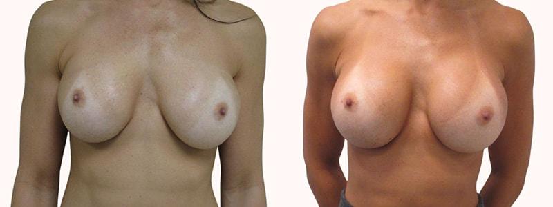 Melanie L. Aya-ay, MD breast augmentation revision result — Tampa, FL