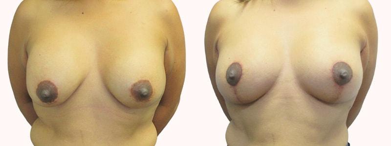 Melanie L. Aya-ay, MD breast lift result — Tampa, FL