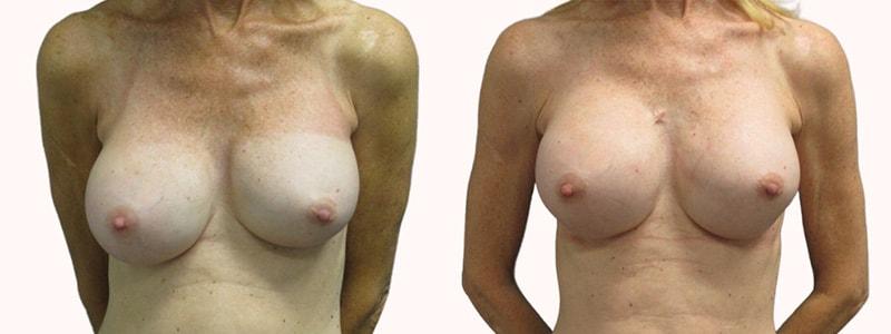 Melanie L. Aya-ay, MD breast augmentation revision result — Tampa, FL