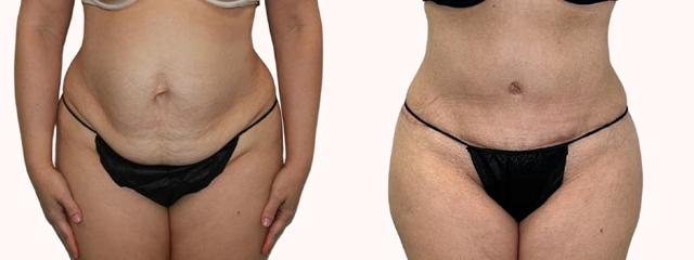 Mini Tummy Tuck result at Melanie L. Aya-ay, MD in Tampa, FL