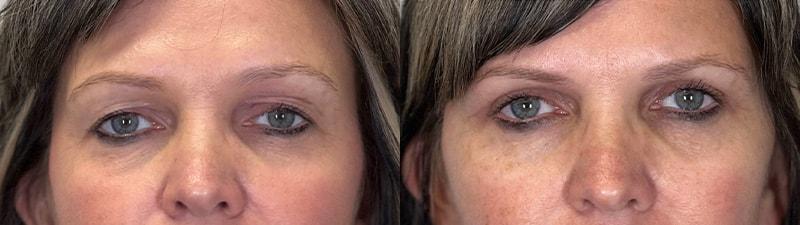 Melanie L. Aya-ay, MD eyelid lift result — Tampa, FL
