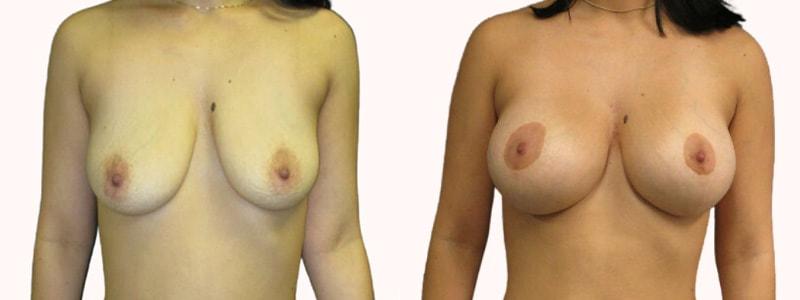 Melanie L. Aya-ay, MD breast lift result — Tampa, FL
