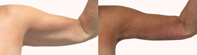Arm Lift result at Melanie L. Aya-ay, MD in Tampa, FL