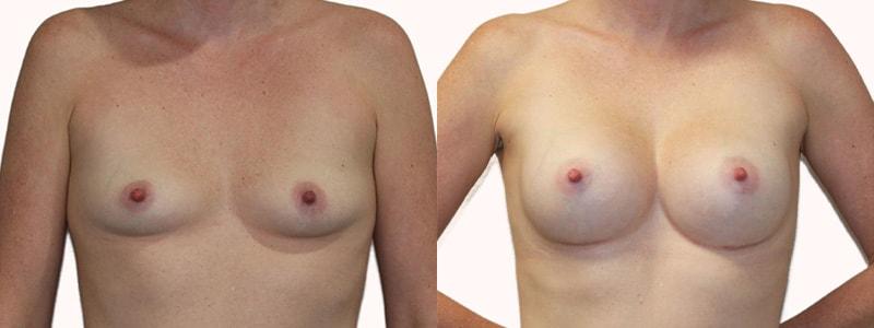 Melanie L. Aya-ay, MD breast augmentation result — Tampa, FL