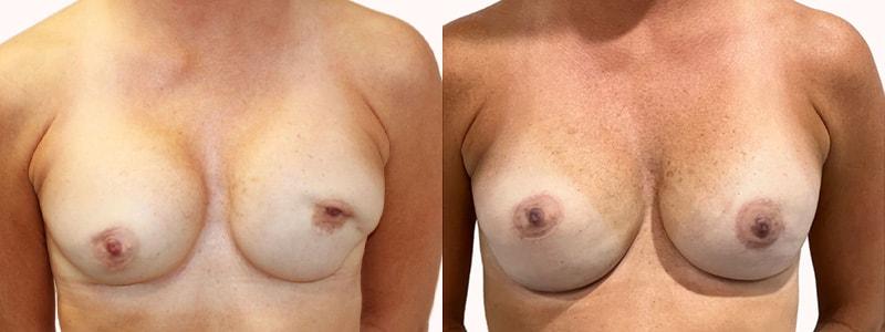 Melanie L. Aya-ay, MD breast augmentation revision result — Tampa, FL